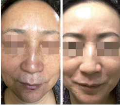 Chemical Peel on the Face to Reduce Spots and Improve Appearance of the  Skin - Clarus Dermatology Medical Surgical Cosmetic Body Sculpting